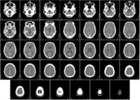 Neurologo non responsabile per l’omesso intervento se il paziente aveva poche possibilità di sopravvivere